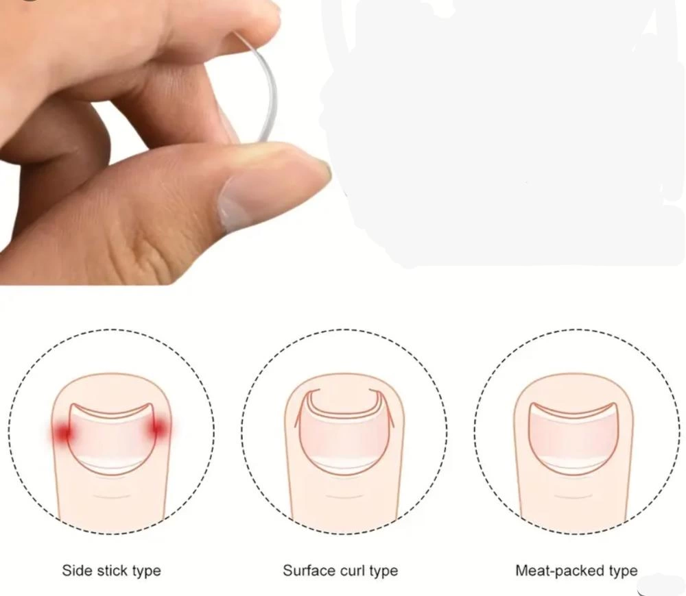 Baş Parmak Tırnak Batmasını Engelleyen Metal Aparat Nrd 603 *